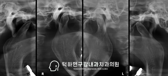 파노라마 및 CBCT 진단 이미지