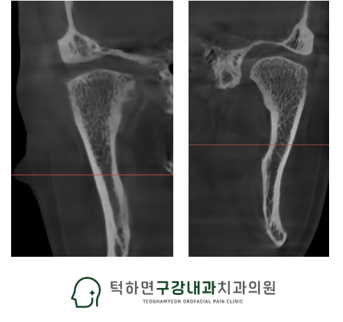 맞춤형 스플린트 장치 이미지