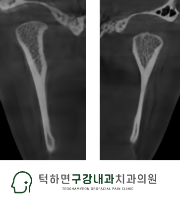 스플린트 장치 관련 이미지