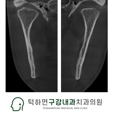 스플린트 장치 및 치료 이미지